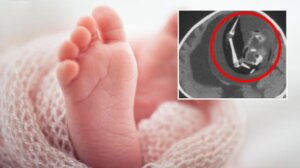 Çin’de bir bebeğin beyninden ikizi çıkarıldı