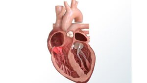 Kalp kapak tedavisinde ameliyatsız yöntemler! Kalp kapak hastalığının tedavisi…