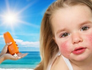 Güneş alerjisine ne yeterli gelir, nasıl geçer? Güneş alerjisi belirtileri…